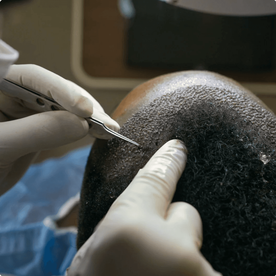 Permanent Hair Reduction