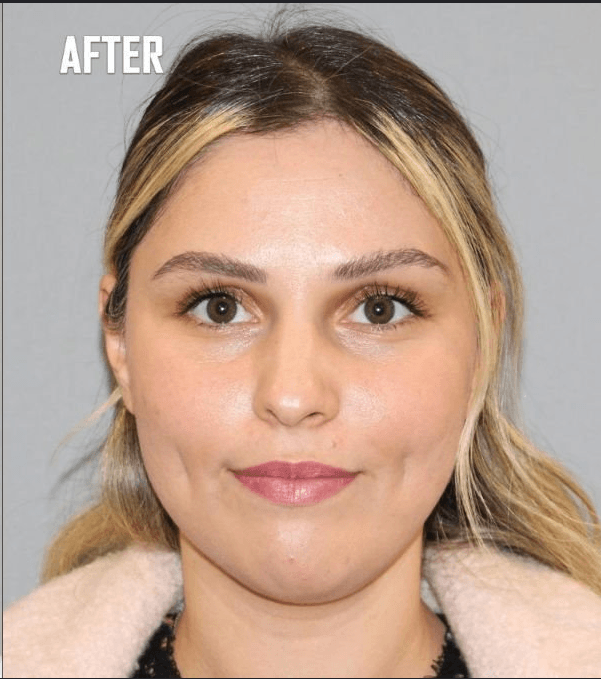 Treatment after outcome