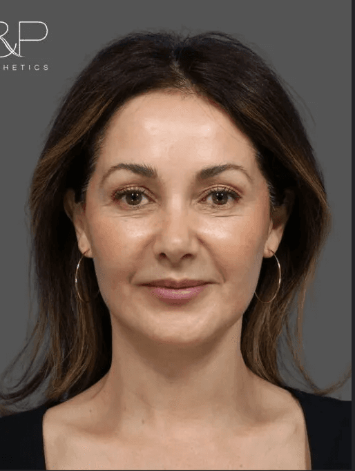 Treatment after outcome