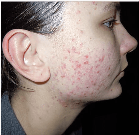 Treatment before concern