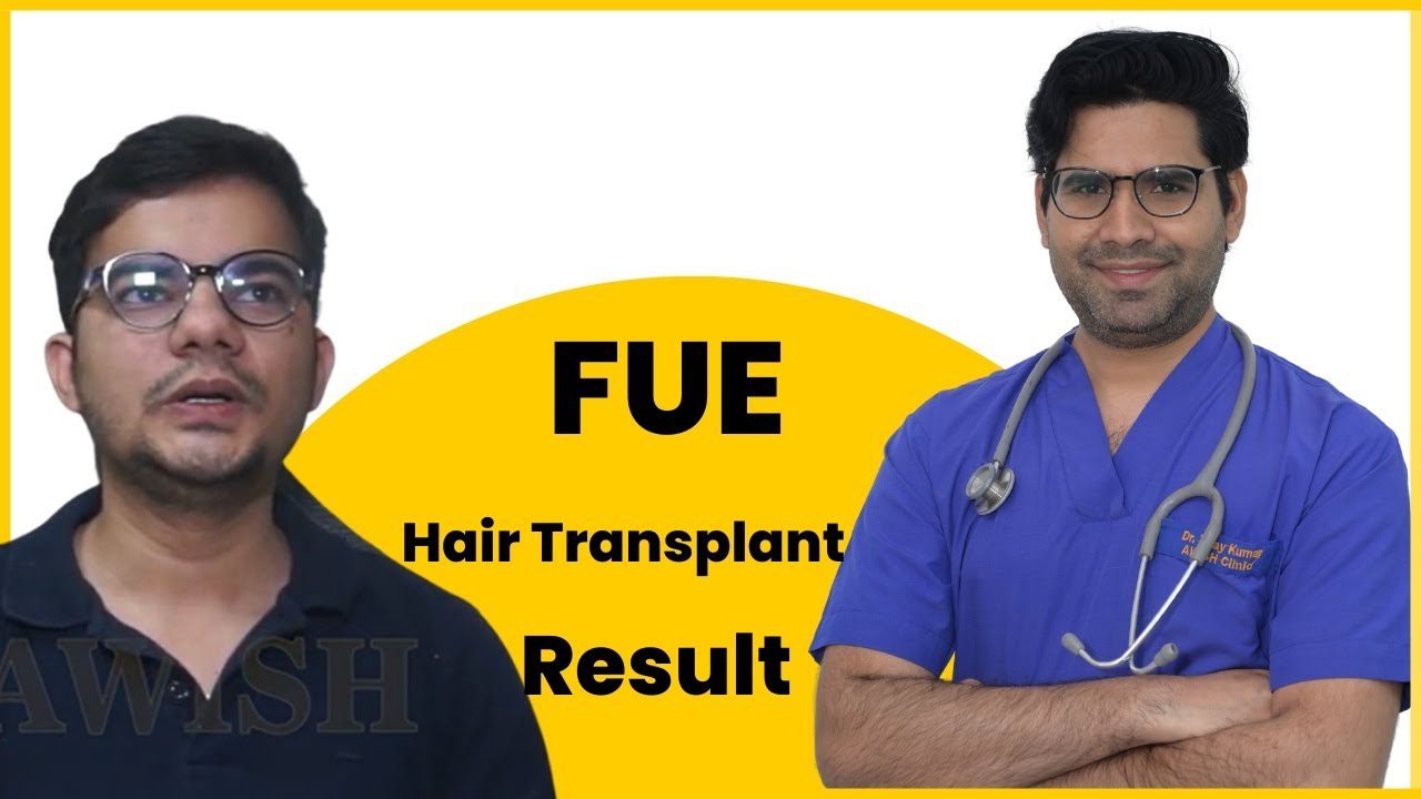 After Hair transplant review