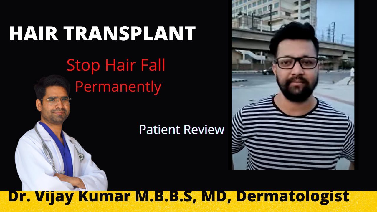Hair Transplant experience