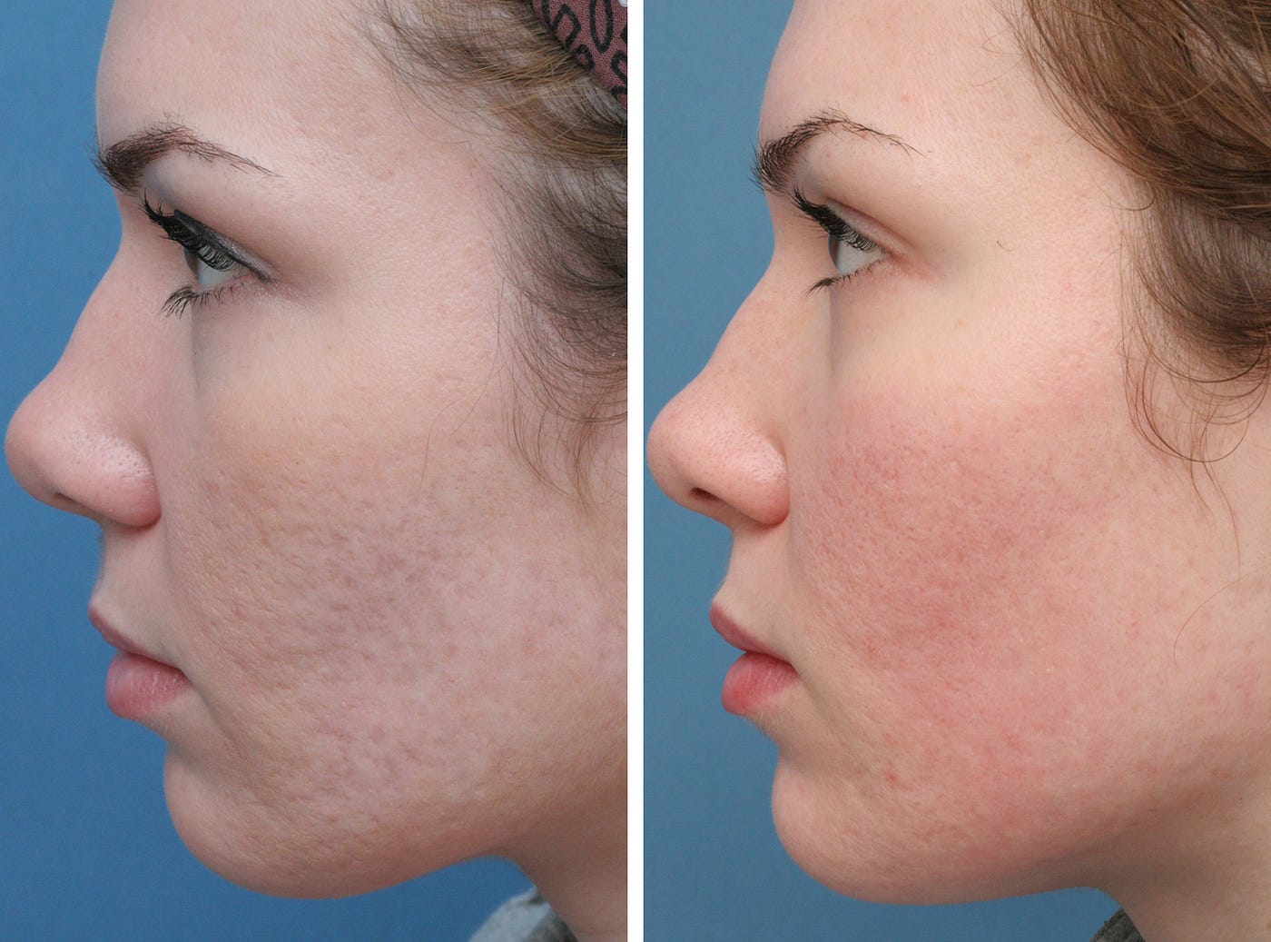 Acne Scars Treatment