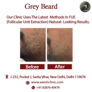 Grey Beard Treatment at AWISH Clinic, Delhi