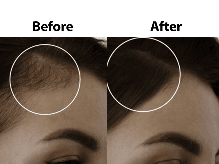 Female pattern baldness | AWISH Clinic