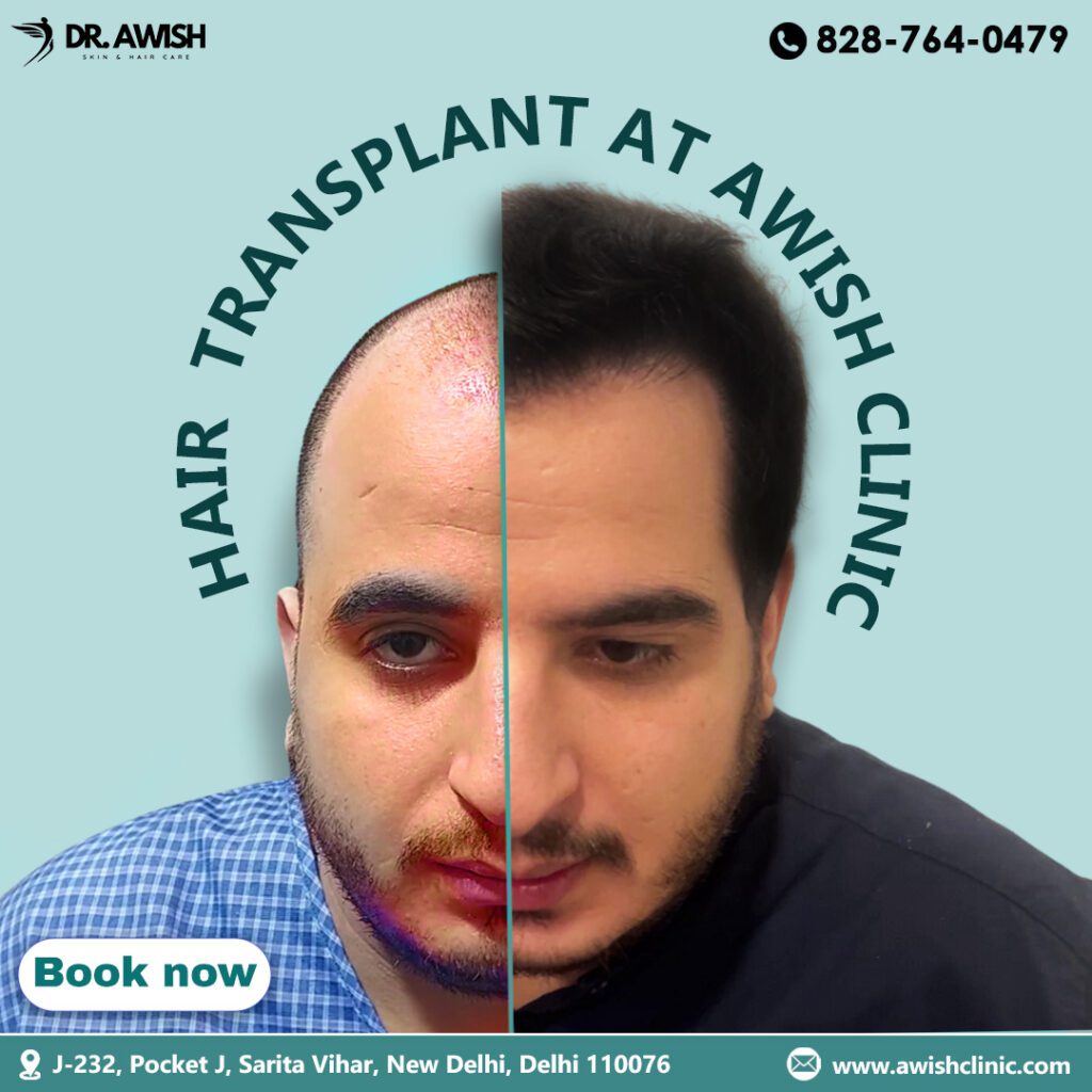 Best FUE Method Hair Transplant Clinic in Delhi NCR​