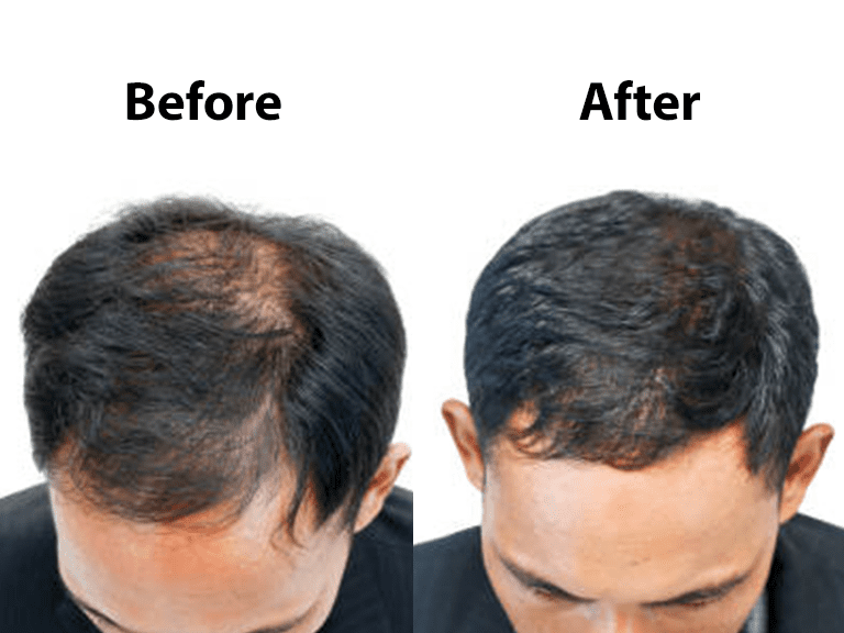 Male Pattern Baldness at AWISH Clinic