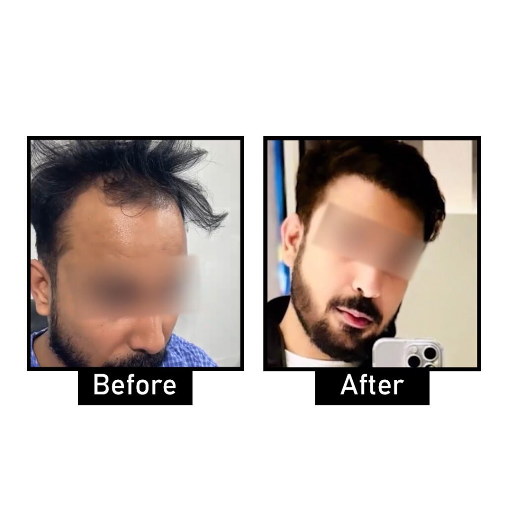 Hair Transplant Results | Hair Transplant Before and After | AWISH Clinic