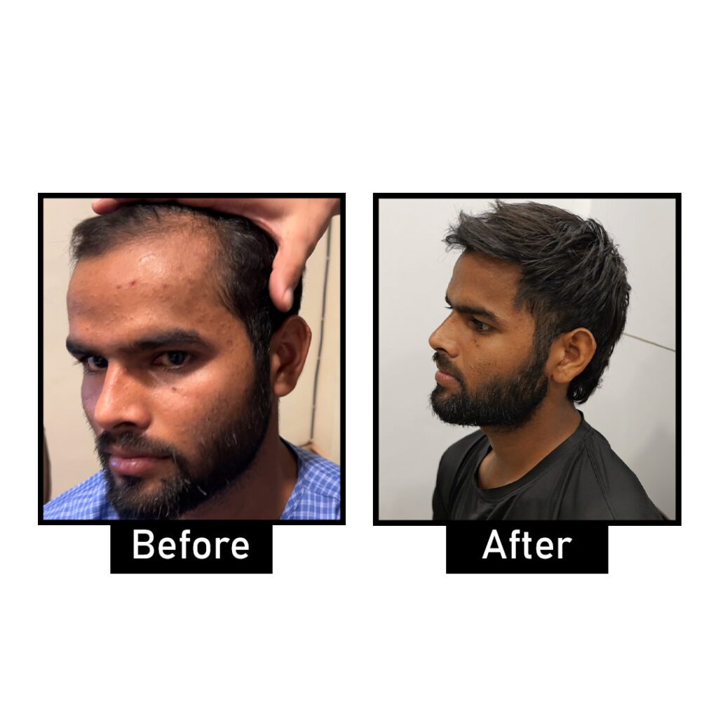 Hair Transplant Results | Hair Transplant Before and After | AWISH Clinic