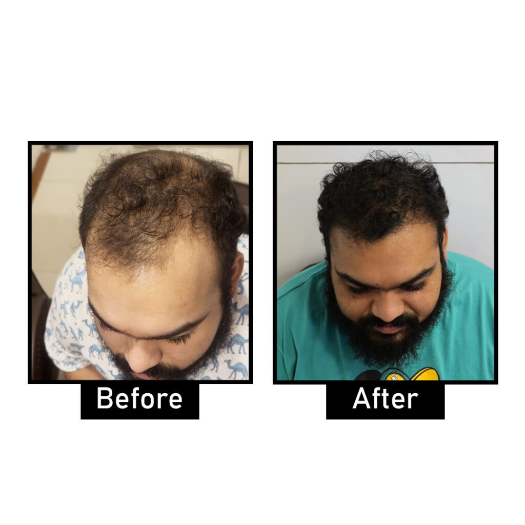 Hair Transplant Results | Hair Transplant Before and After | AWISH Clinic