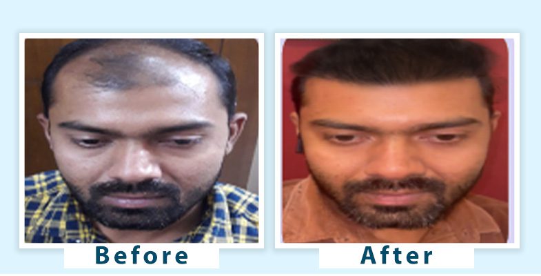 Hair Transplant Results | Hair Transplant Before and After | AWISH Clinic