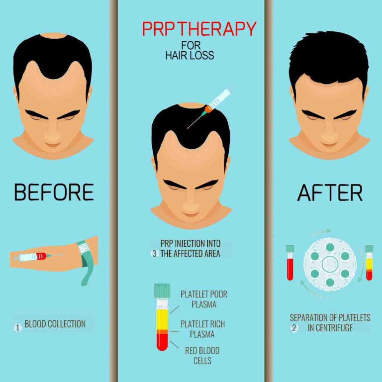 PRP Treatment for hair loss