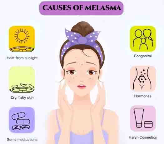 causes of melasma