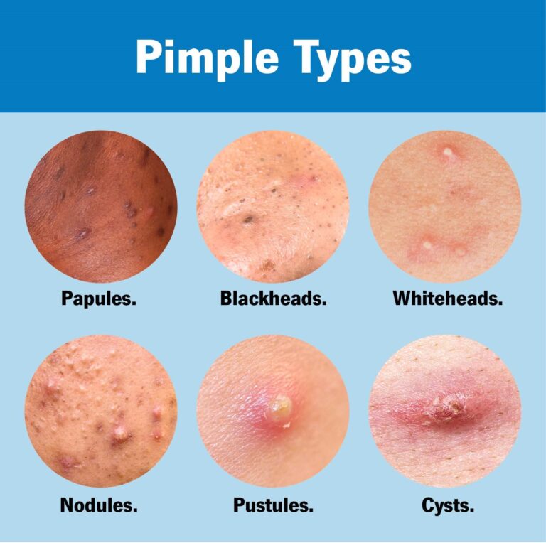 types of pimples