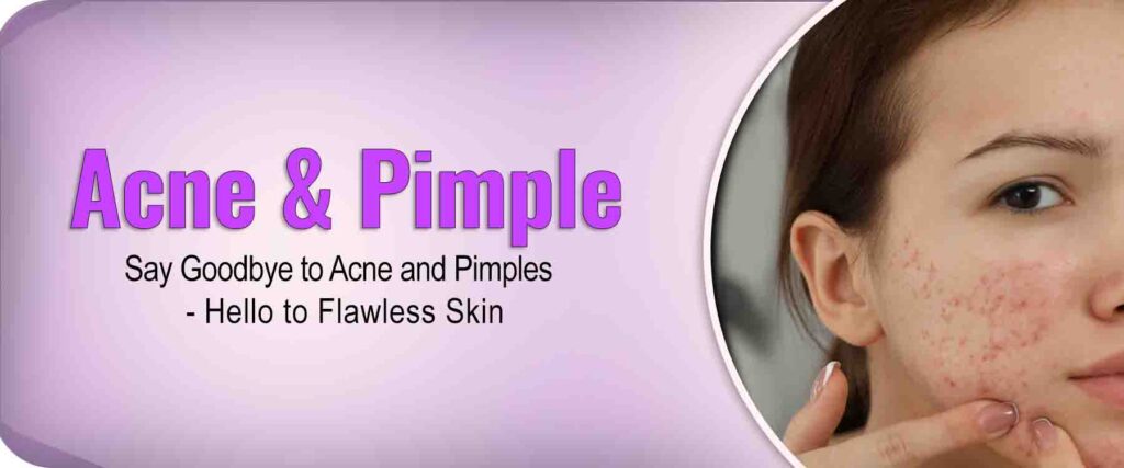 Acne and Pimple treatment