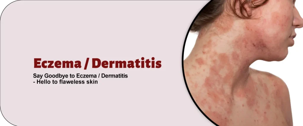 Eczema Dermatitis