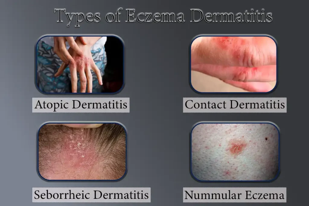 Types of Eczema Dermatitis