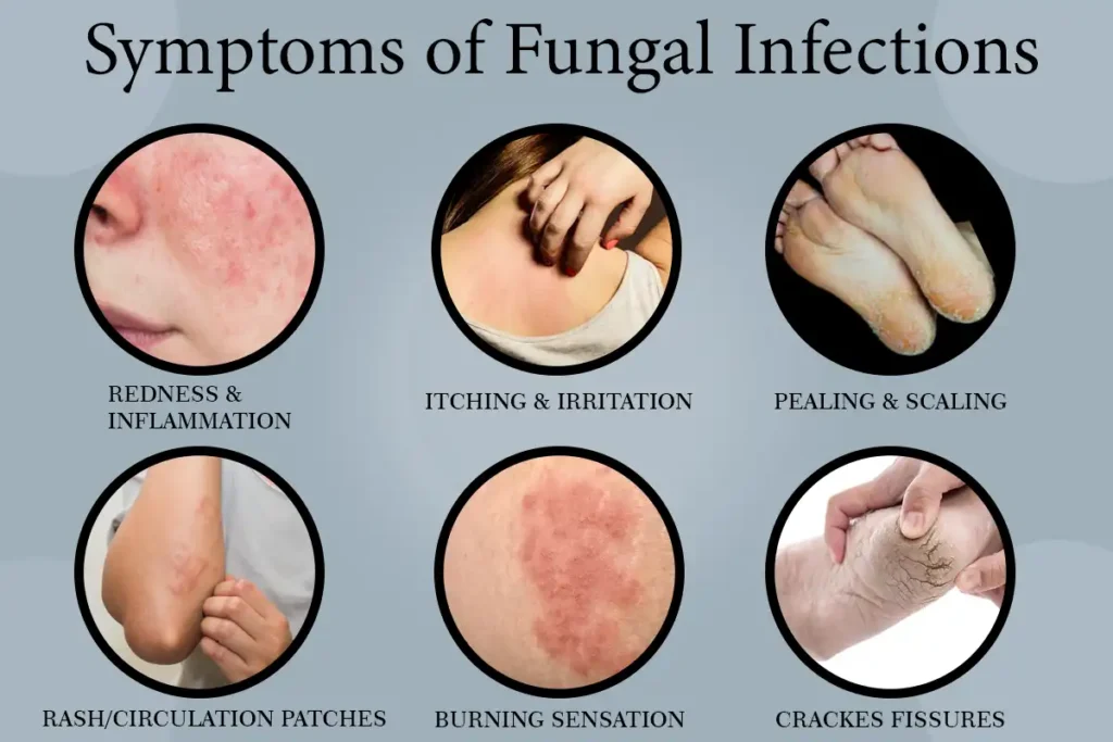 Symptoms to Watch For Fungal Infections