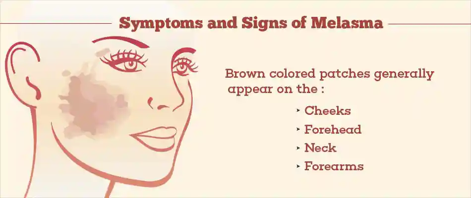 Symptoms & Sign of Melasma​