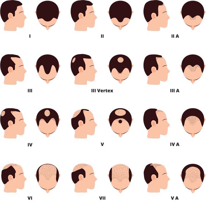 Male hair loss stage