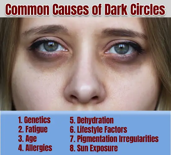 Common Causes of Dark Circles