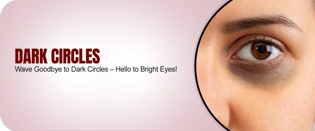 Dark Circles: Causes, Treatment and Prevention​