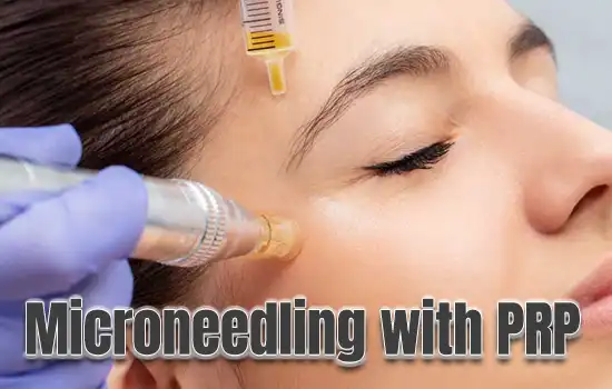 Microneedling with PRP