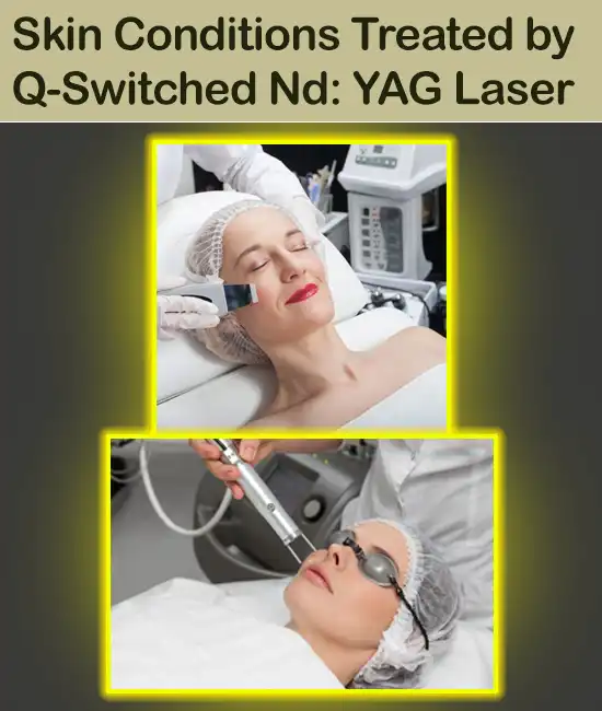 Skin Conditions Treated by Q-Switched Nd: YAG Laser​