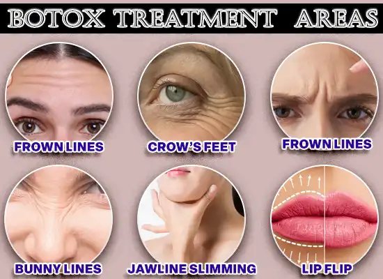 Botox Treatment Areas​