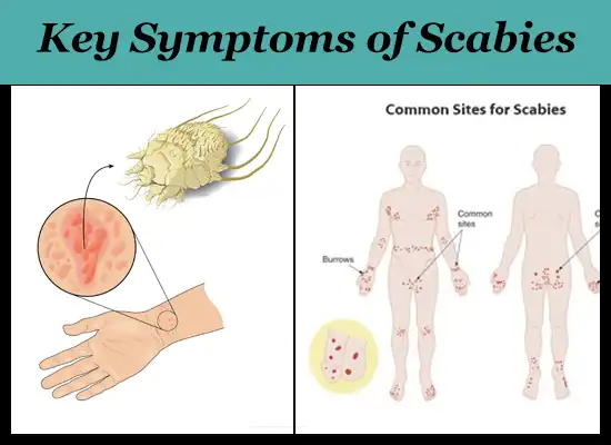 Key Symptoms of Scabies