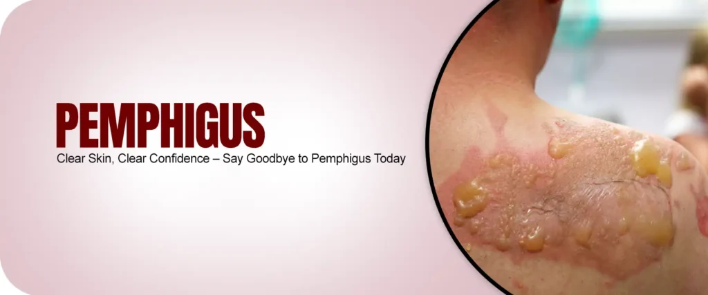 Pemphigus: Causes, Symptoms, and Analysis at AWISH Clinic