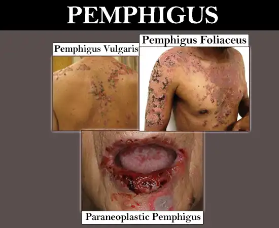 What is Pemphigus?​