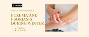 Managing Eczema and Psoriasis in Winter